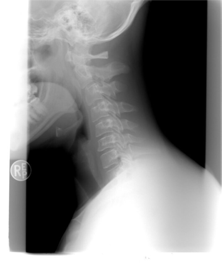 Joint Hypermobility in The Cervical Spine and The Risk of Early Onset Degenerative Osteoarthritis